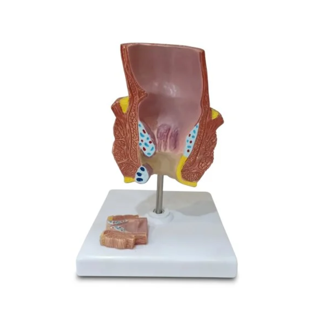 Diseased Rectum Model