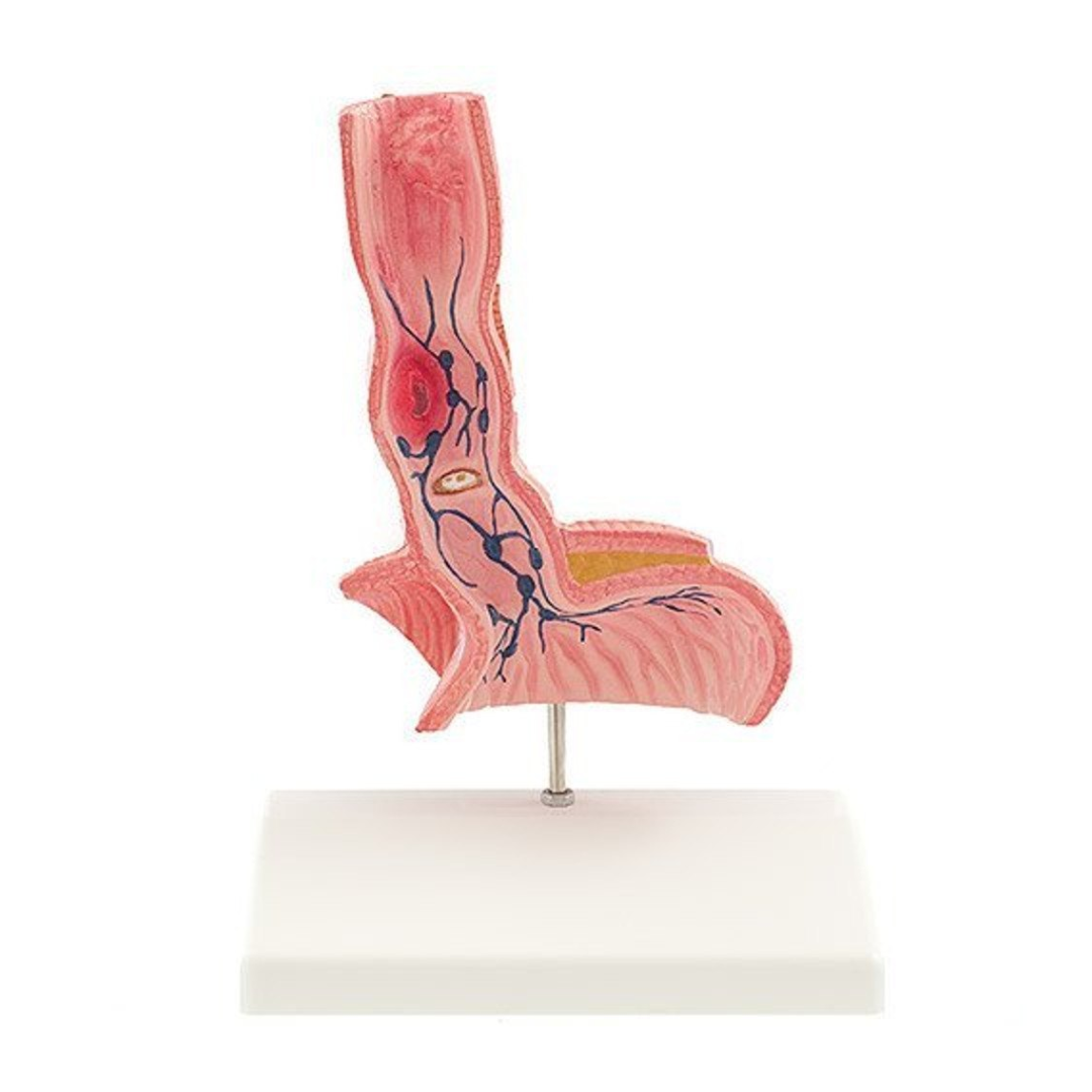 Diseased Esophagus Model