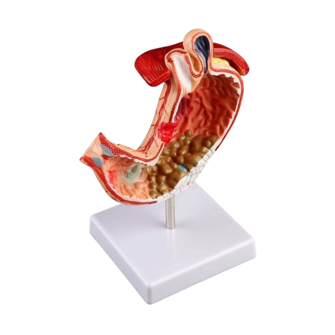 Diseased Stomach Model