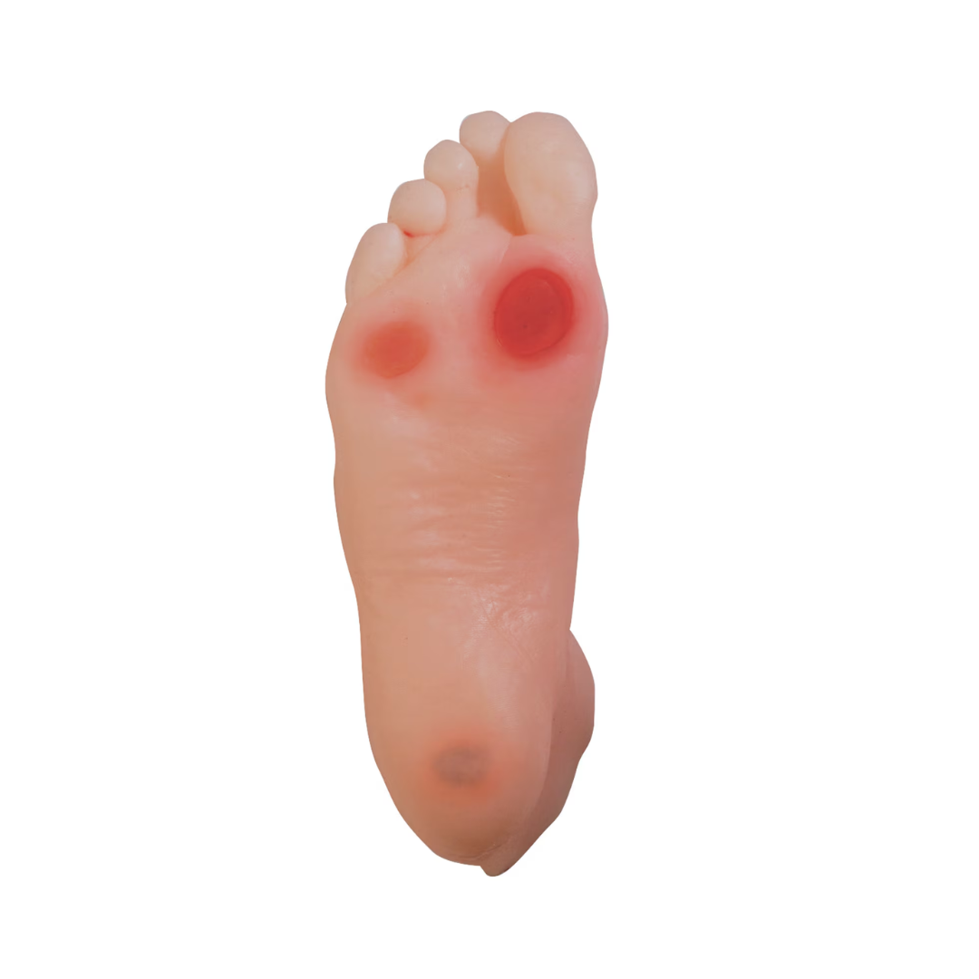 Diabetic Foot Model