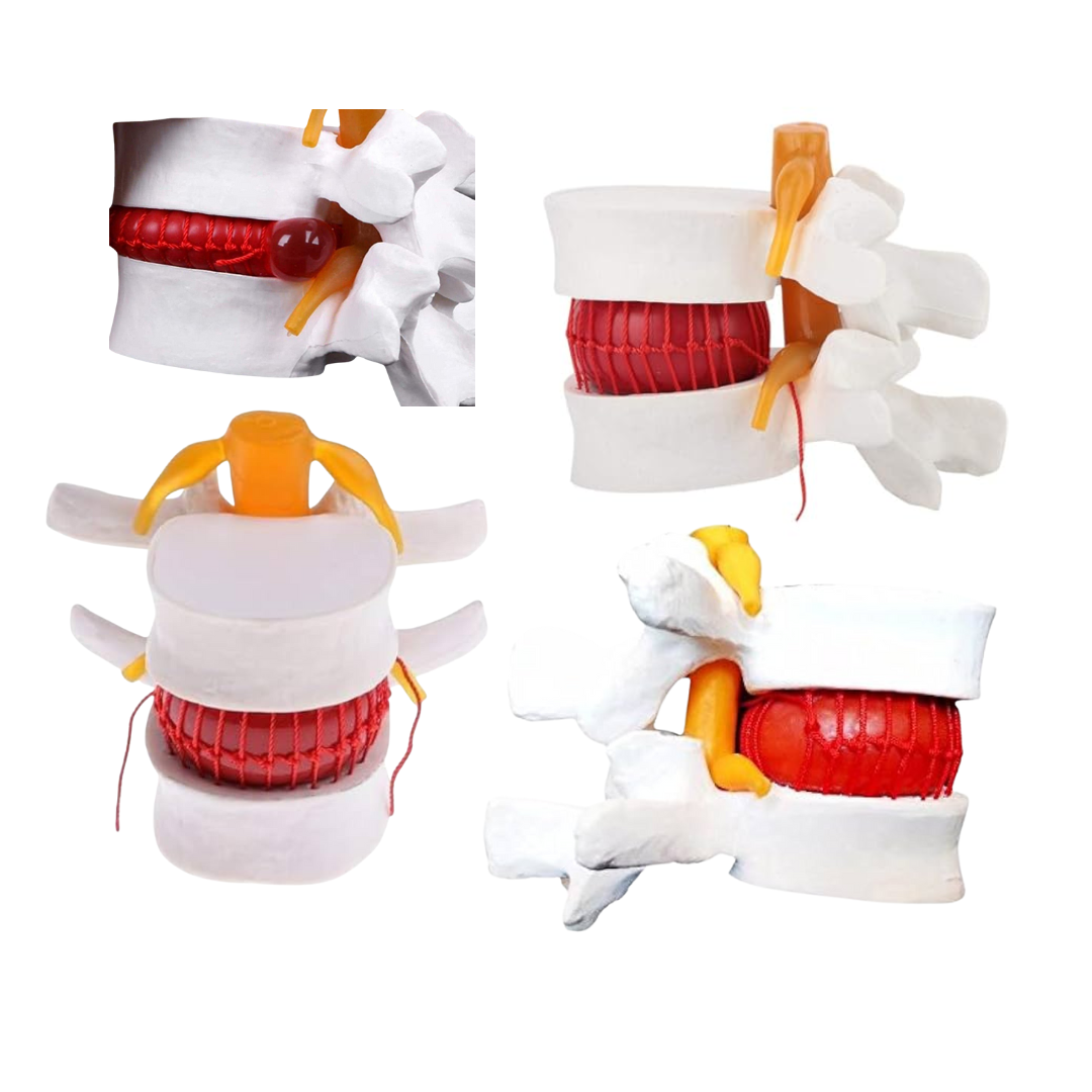 Disc Prolapse Simulator