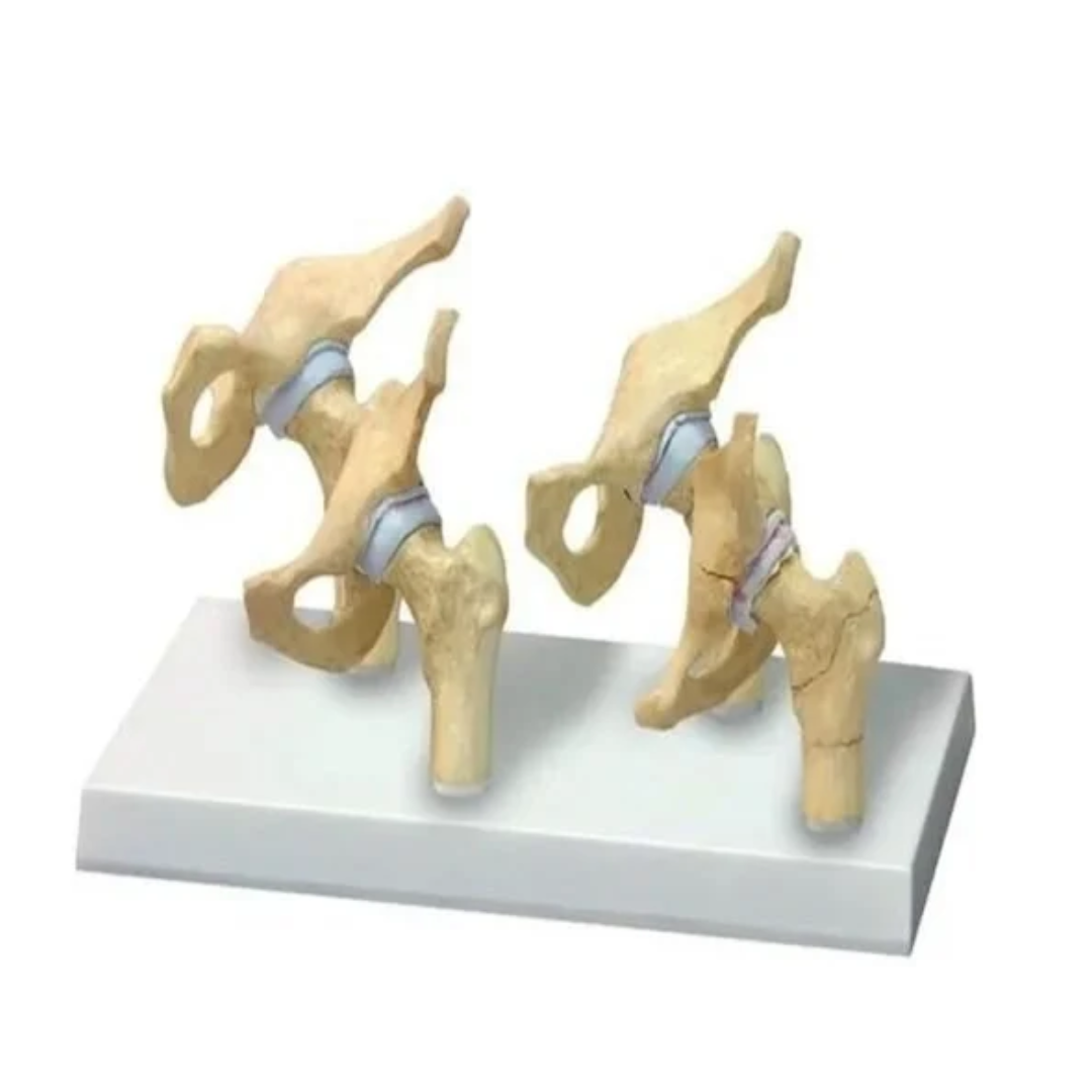 Stages Osteoarthritis Hip Model