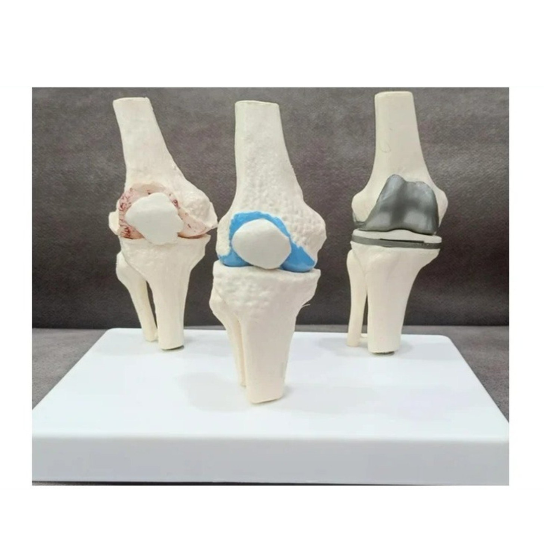 Stage Arthritis Knee Model with Implant