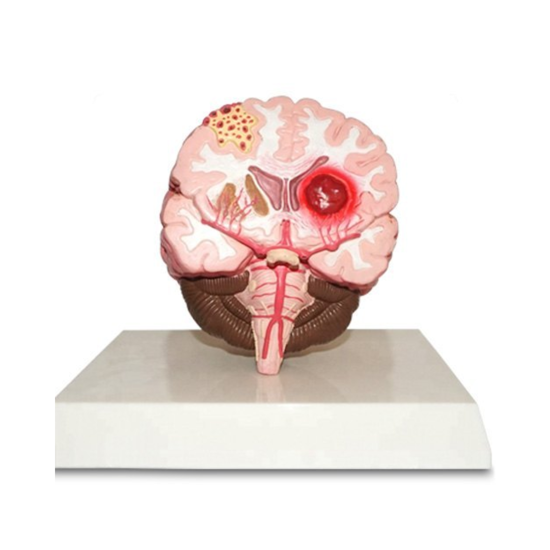 Brain Stroke Model
