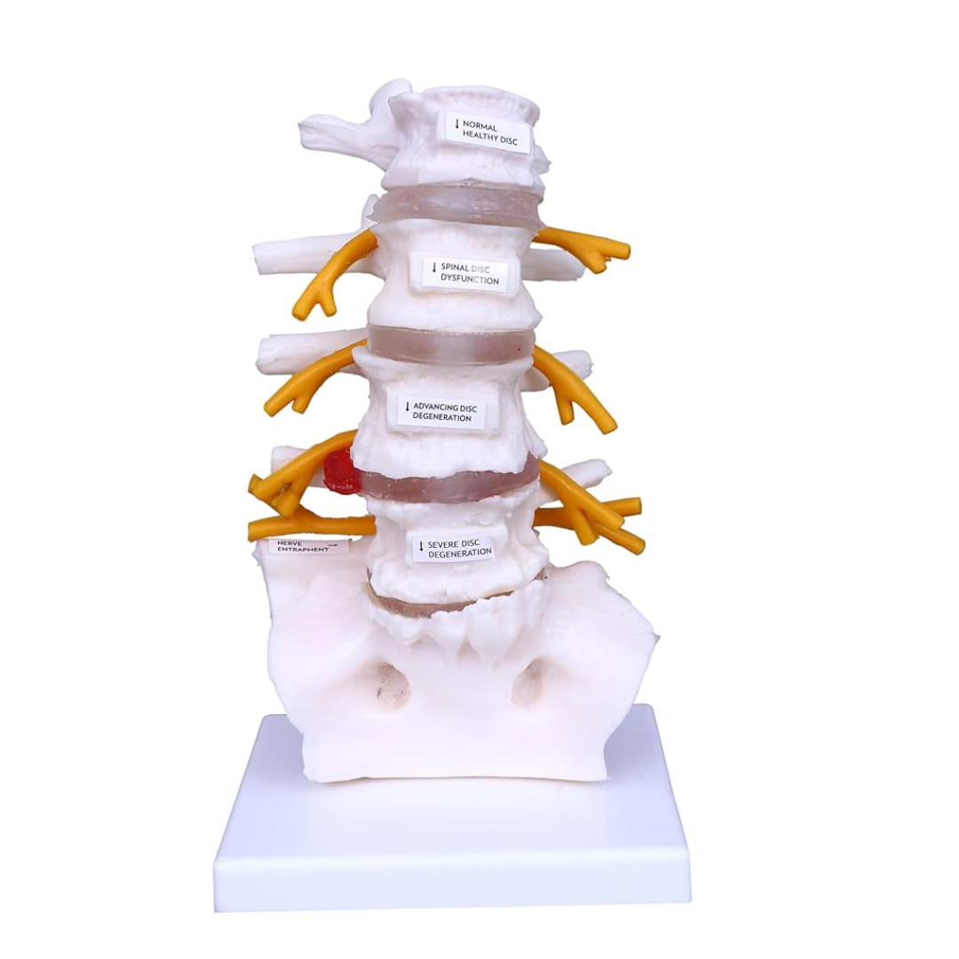 Diseased Lumbar Spine Model