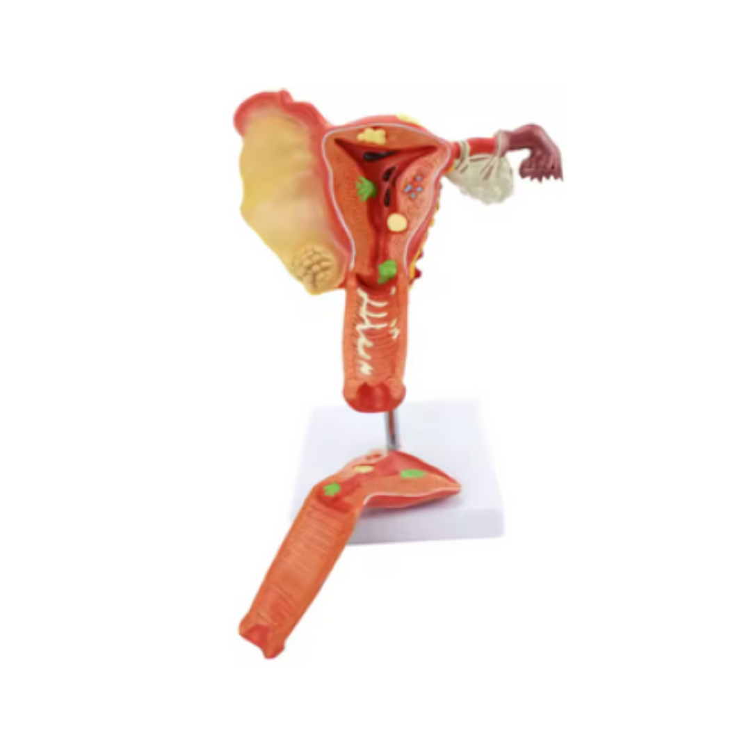 Pathological Uterus Model