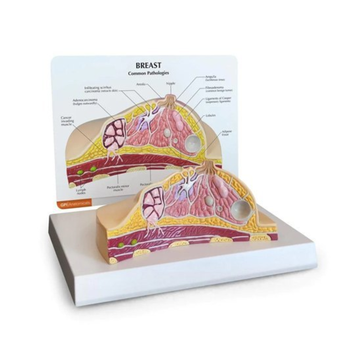 Diseased Breast Model