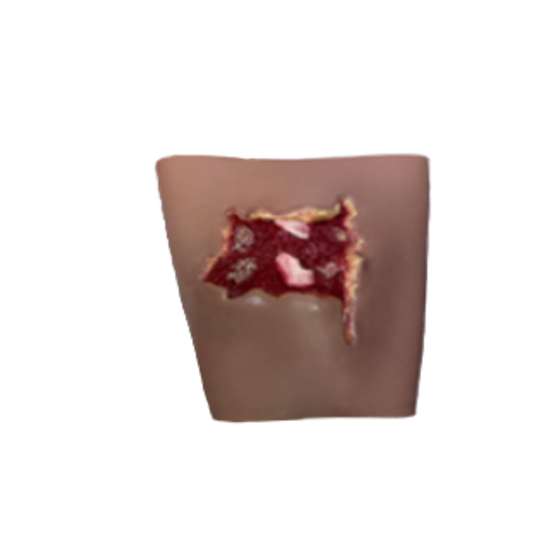 Wearable Fractures Wound Sleeve