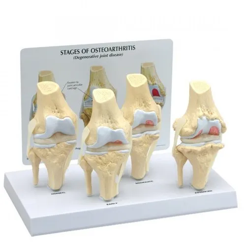 4 Stages KneeArthritis Model