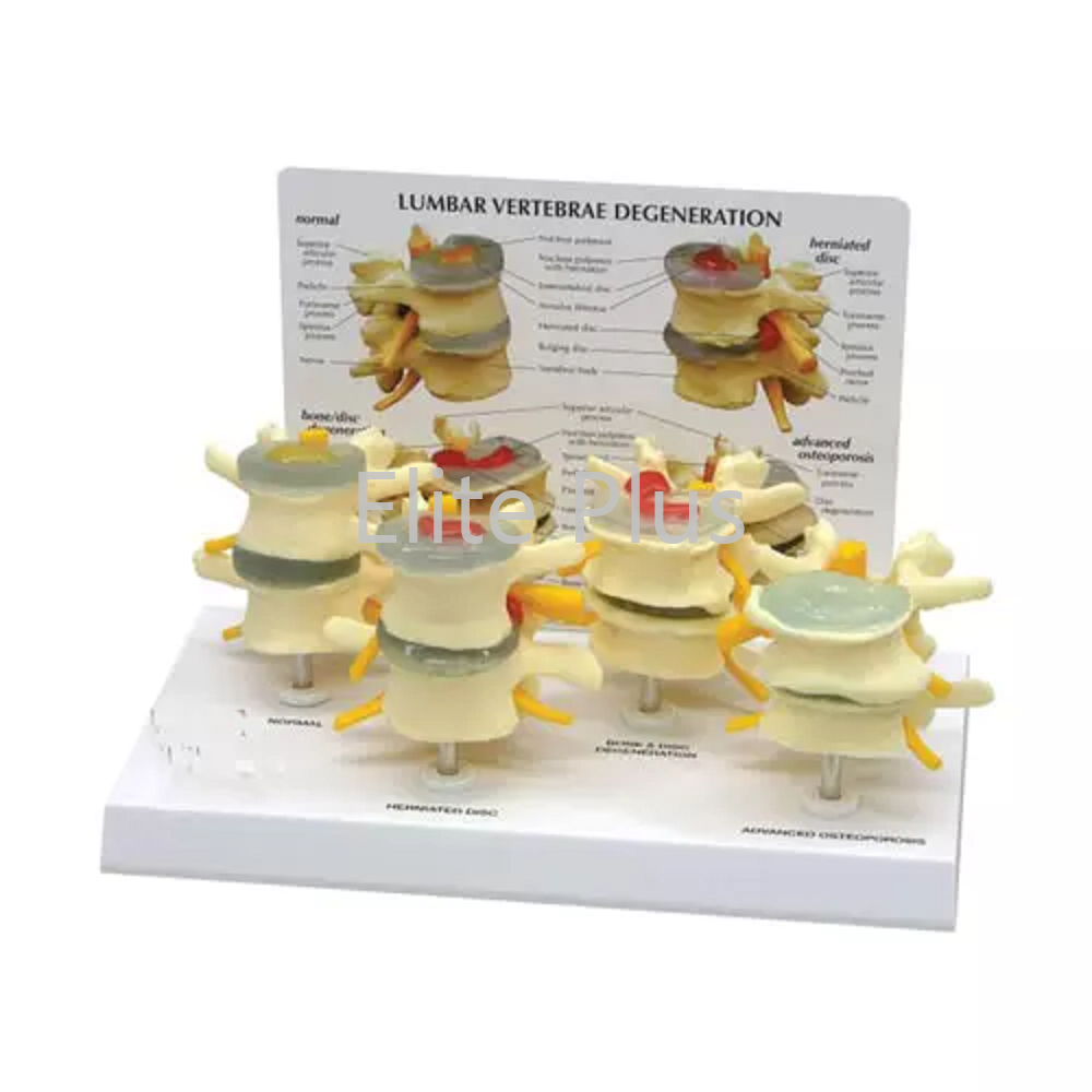 Lumbar Vertebrae Degeneration Model