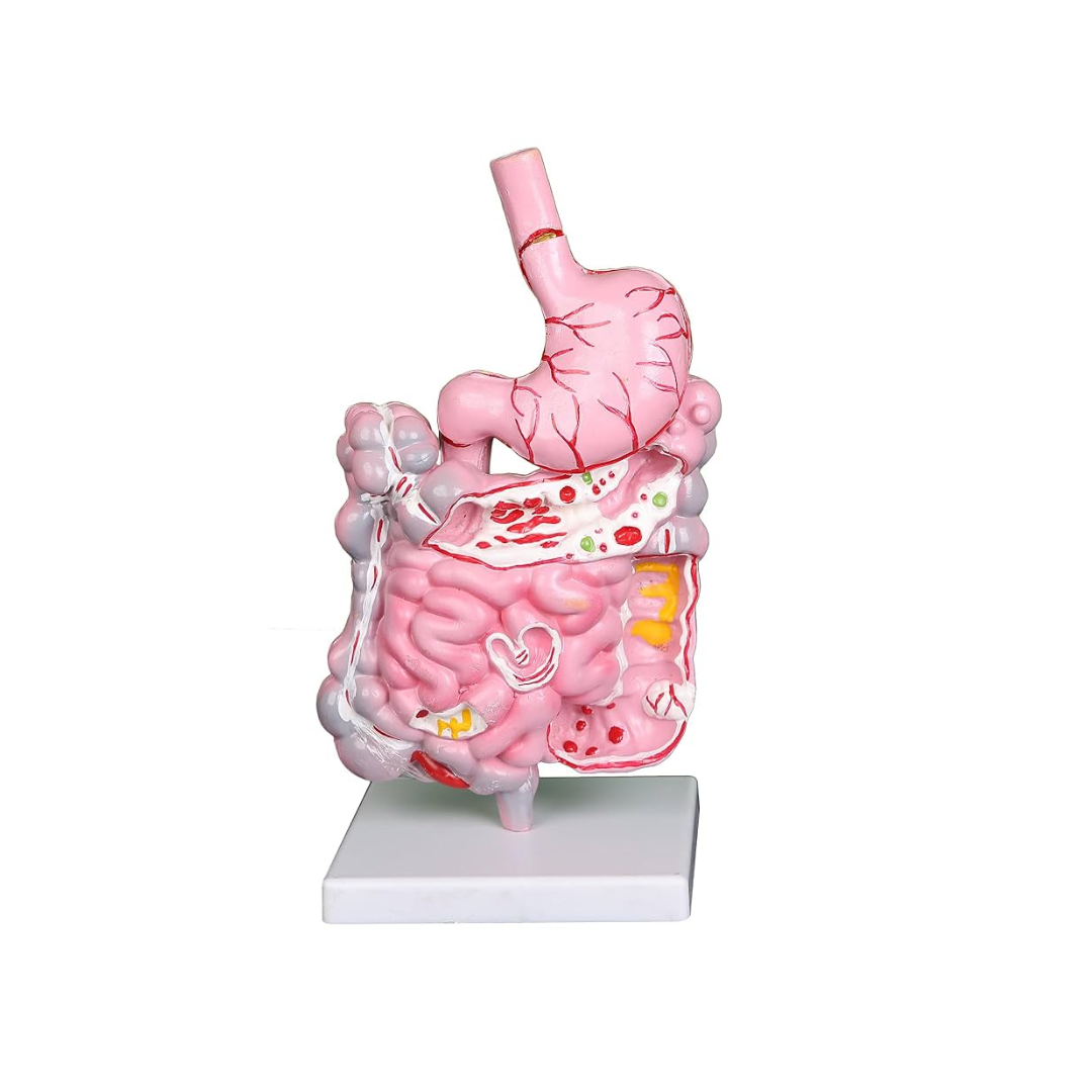 Diseased Digestive System Model