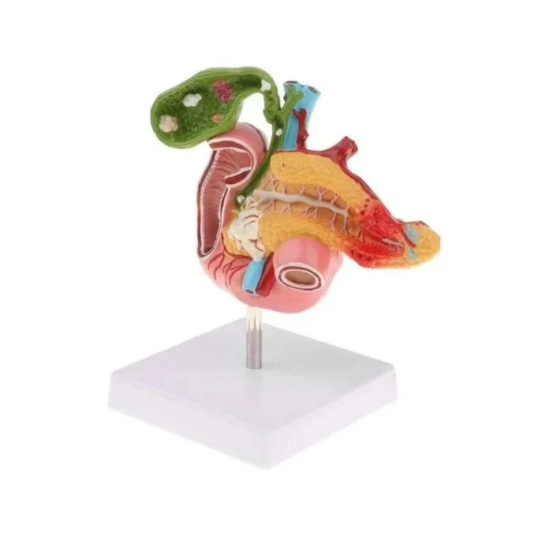 Diseased Pancreas,Spleen and Gall Bladder Model