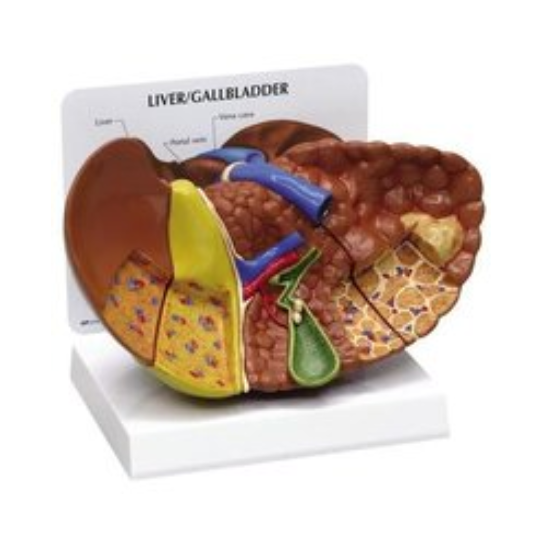 Diseased Liver Model