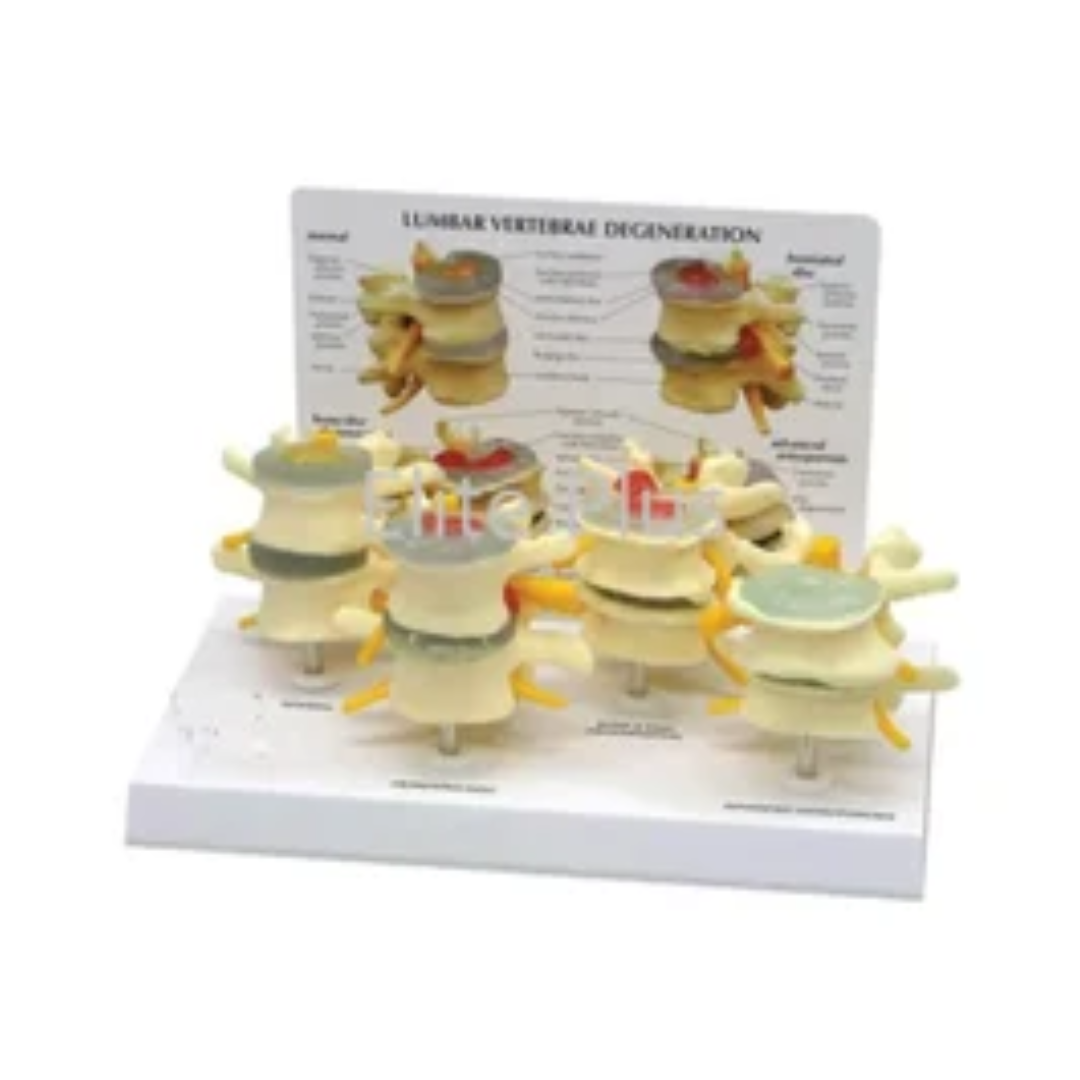 Lumbar Vertebrae Degeneration Model