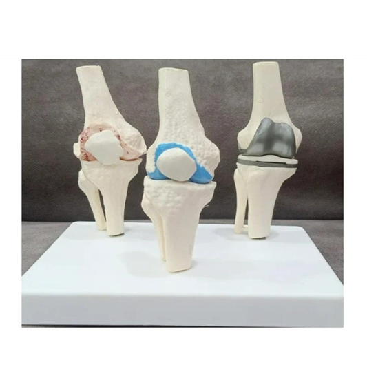 Stage Arthritis Knee Model with Implant