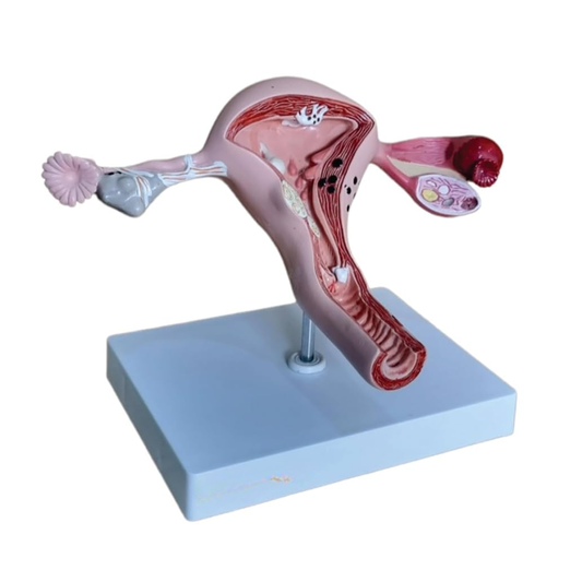 Diseased Uterus Model