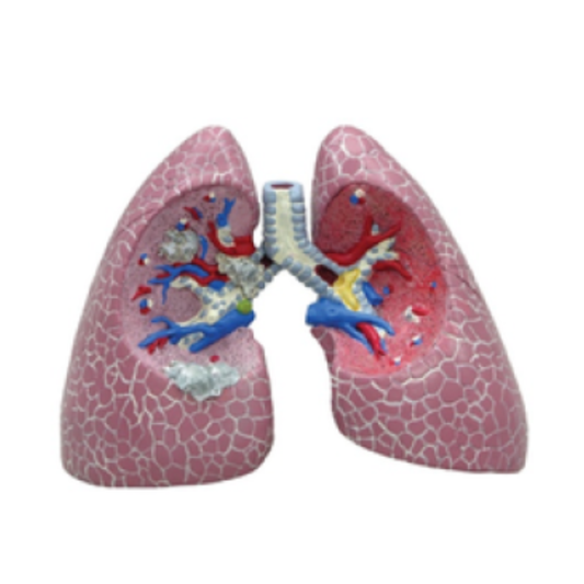 Lung Disease Model