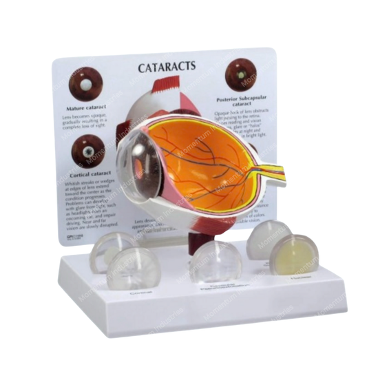 Human Cataract Eye Model