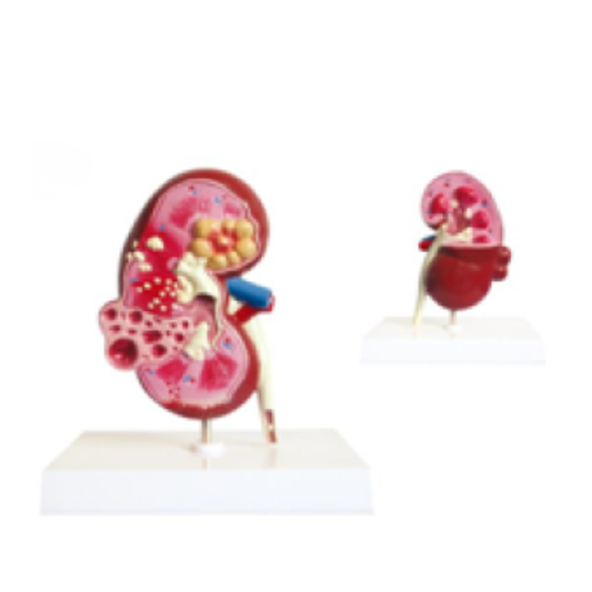 Kidney Cyst Model