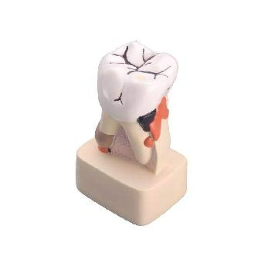 Diseased Tooth Model