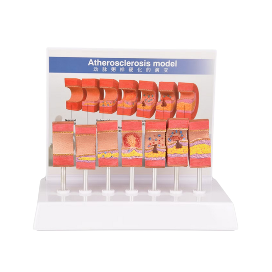 Artery Lesion Sclerosis Model