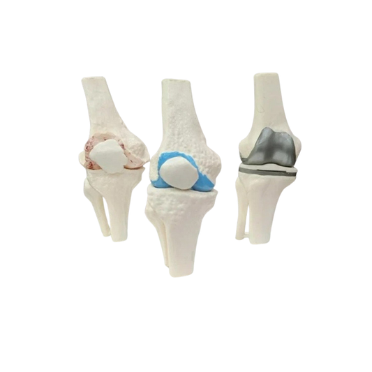 3 Stage Arthritis Knee Model with Implant