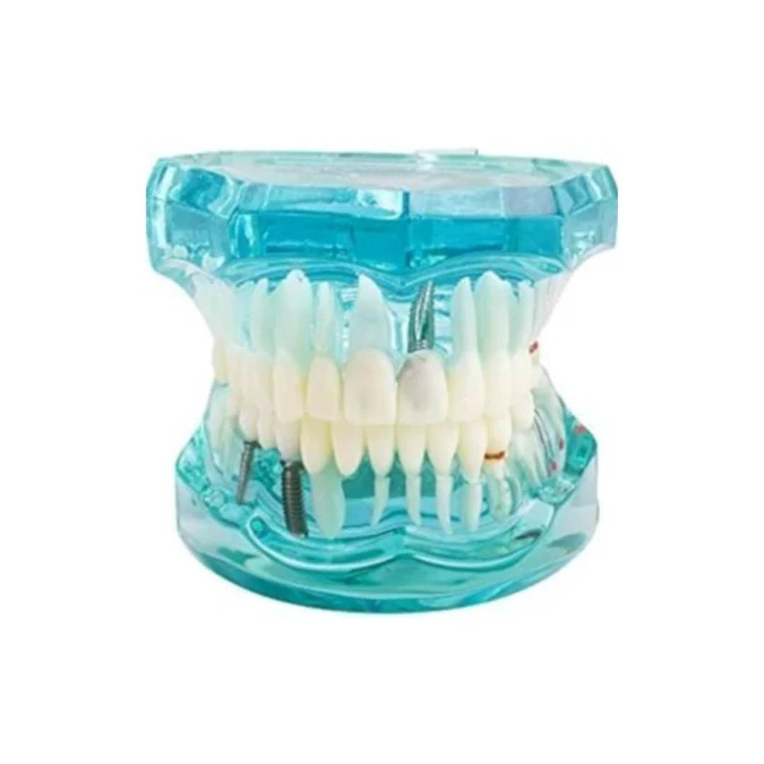 Transparent Dental Implantation Tooth Model