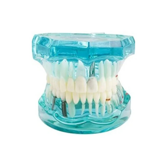 Transparent Dental Implantation Tooth Model