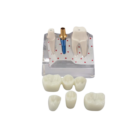 Transparent Enlarged Dental Implant Anatomy Model