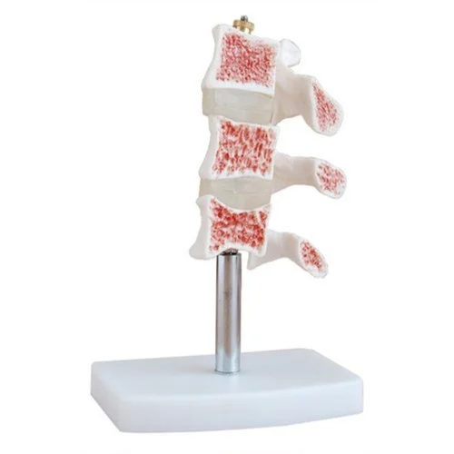 Vertebral Osteoporosis Model